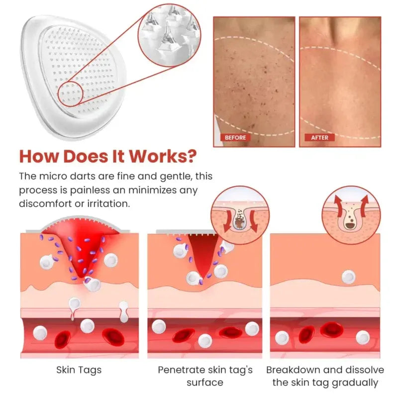 Derma Smooth Skin Tag Removal PatchDERMA SMOOTH SKIN TAG REMOVAL PATCH