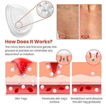 Derma Smooth Skin Tag Removal PatchDERMA SMOOTH SKIN TAG REMOVAL PATCH