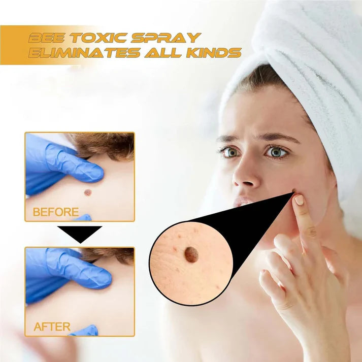 Bee Venom Skin Tag & Wart Remover Spray - Rs.1499/-