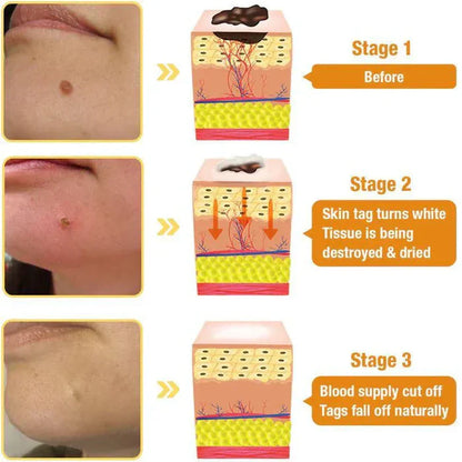 Bee Venom Skin Tag & Wart Remover Spray - Rs.1499/-